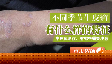 孩子头上患银屑病怎么办